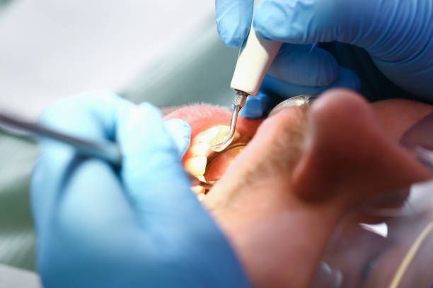 Best Emergency Root Canal Treatment in Columbiana, OH
